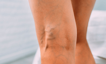 Qué son las varices y cómo tratarlas