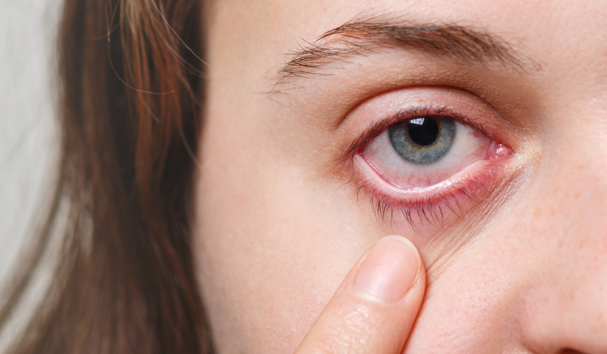 Fotoqueratitis, qué es, síntomas y tratamiento. Fotoqueratitis, qué es, síntomas y tratamiento.