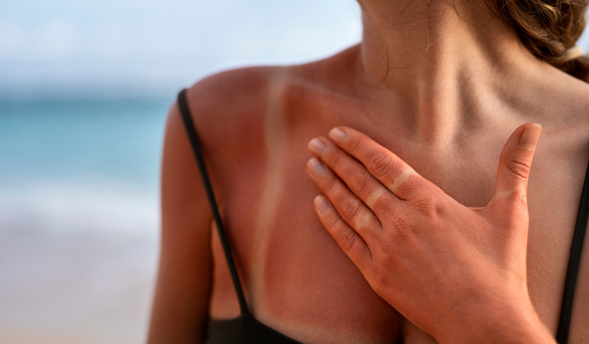 Cuerpo de una mujer quemado por el sol.