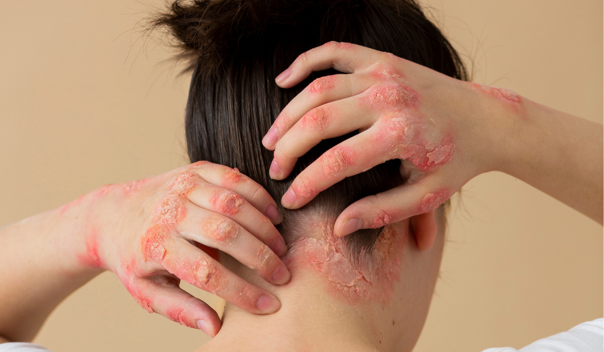 Psoriasis, consejos para controlarla